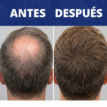 Follicle™ - Rellenador Capilar