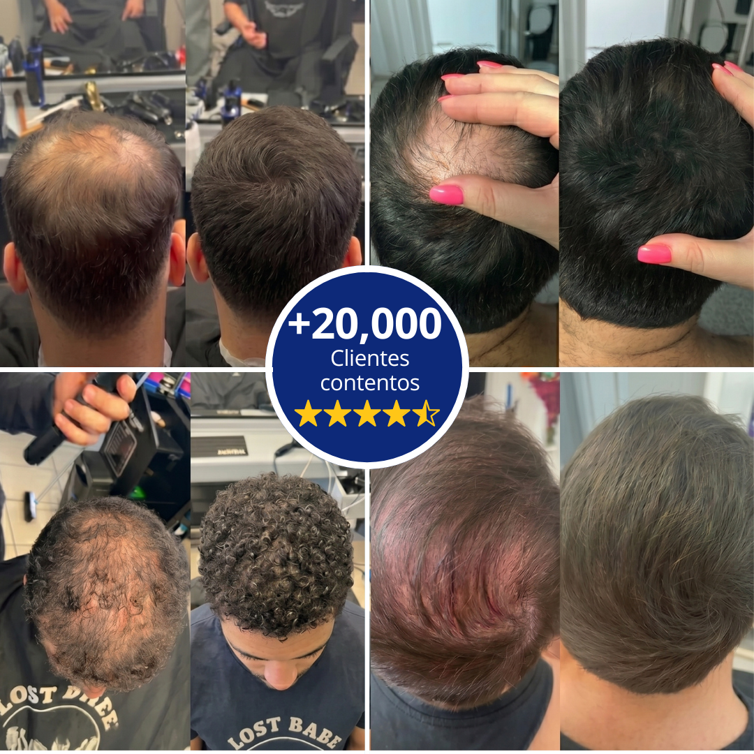 Follicle™ - Rellenador Capilar